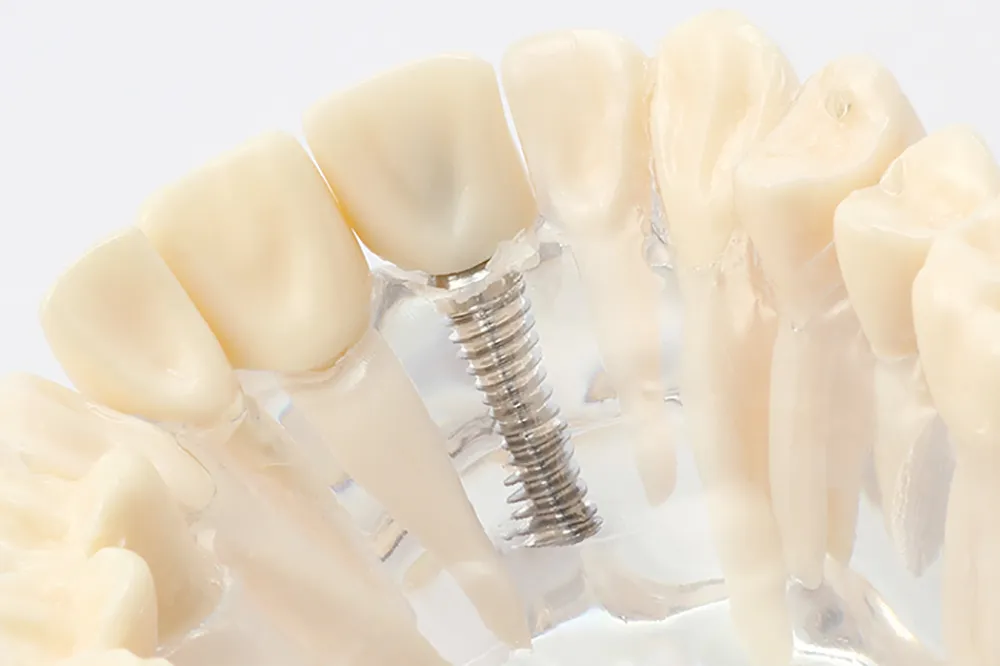 天然歯と変わらない機能・審美性を再現するインプラント